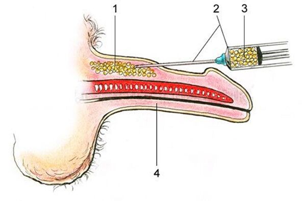 Lipofilling l'introduzione di tessuto adiposo nell'asta del pene
