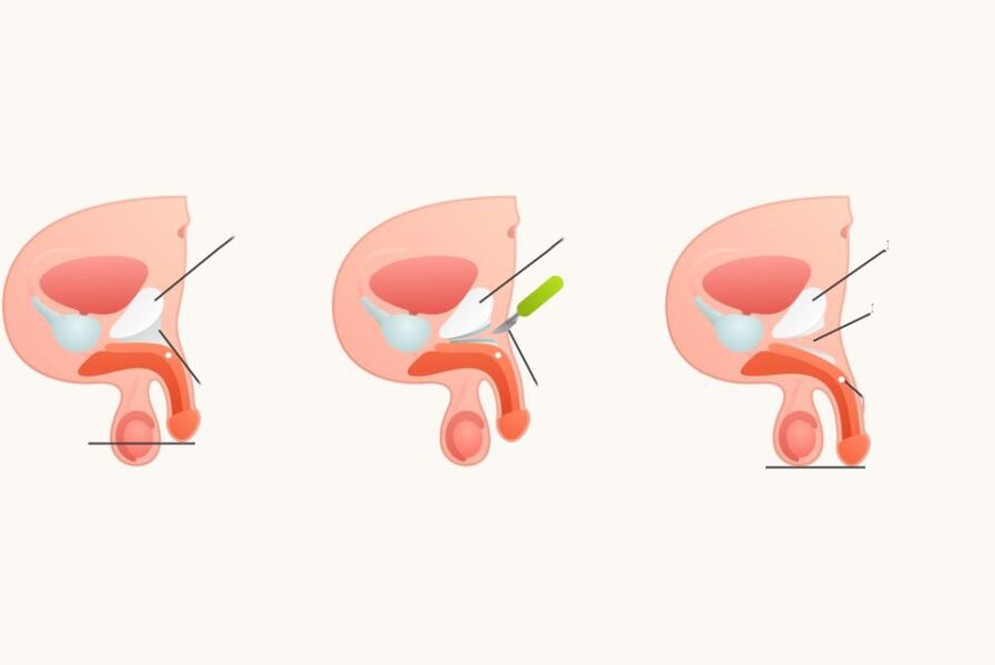 Ligamentotomia per aumentare il pene
