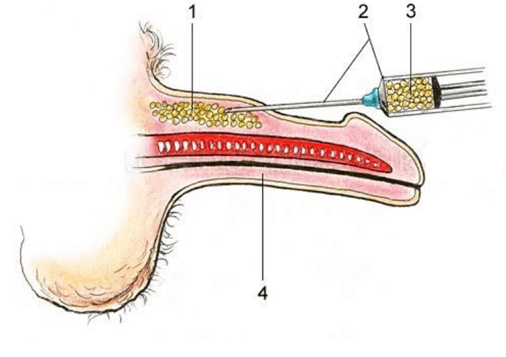 lipofiling per aumentare un membro