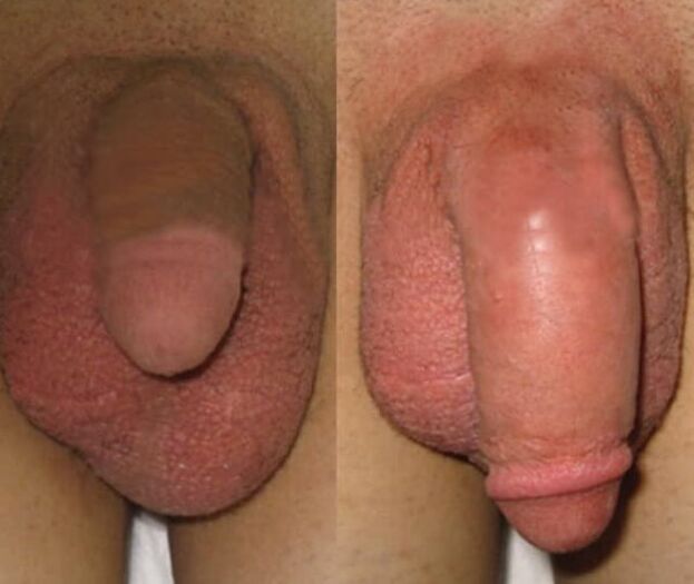 Il risultato dell’installazione di una matrice di collagene nel pene
