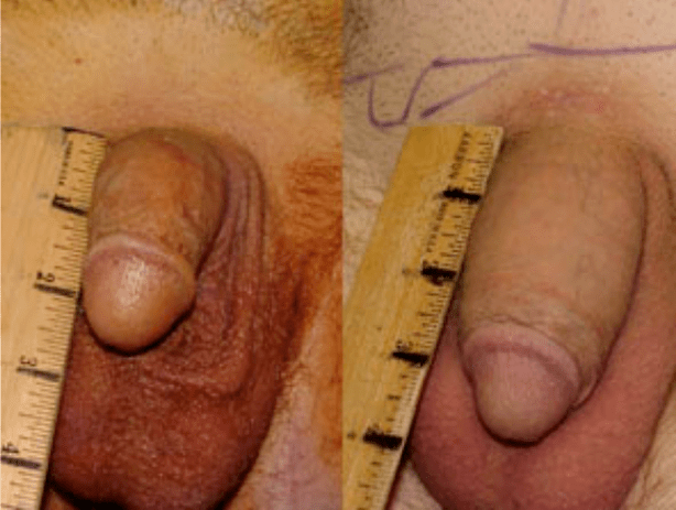 Prima e dopo il lipofilling e l'impianto di gel