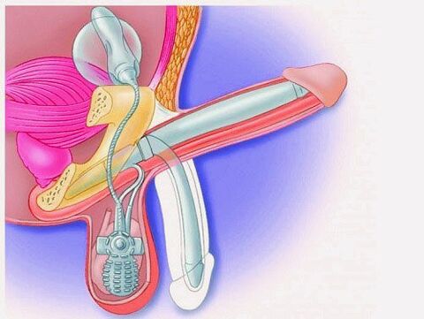 Ingrandimento del pene tramite protesi peniena